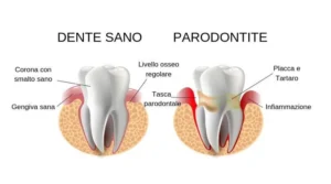 Parodontite Matera